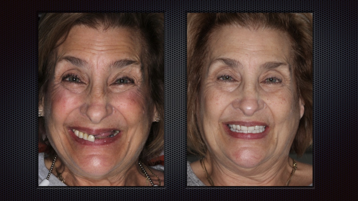 A patient's smile before and after full-arch dental implants