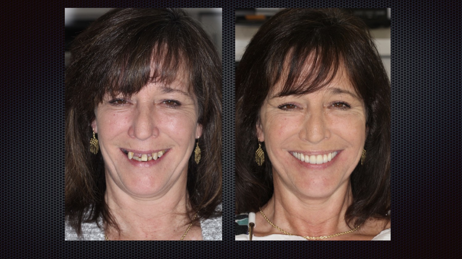 Before and after full-arch implant results