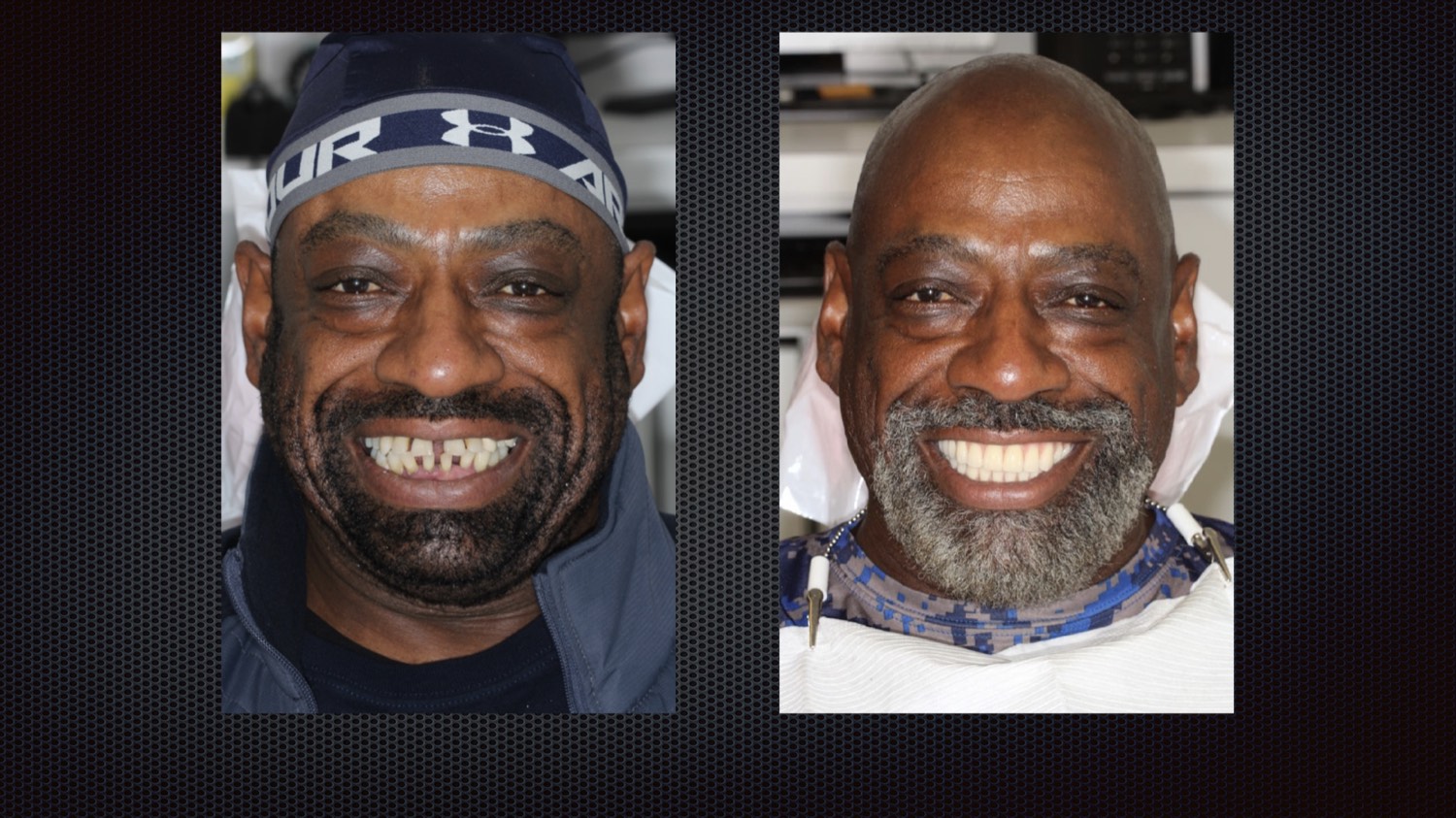 Before and after full-arch implant results