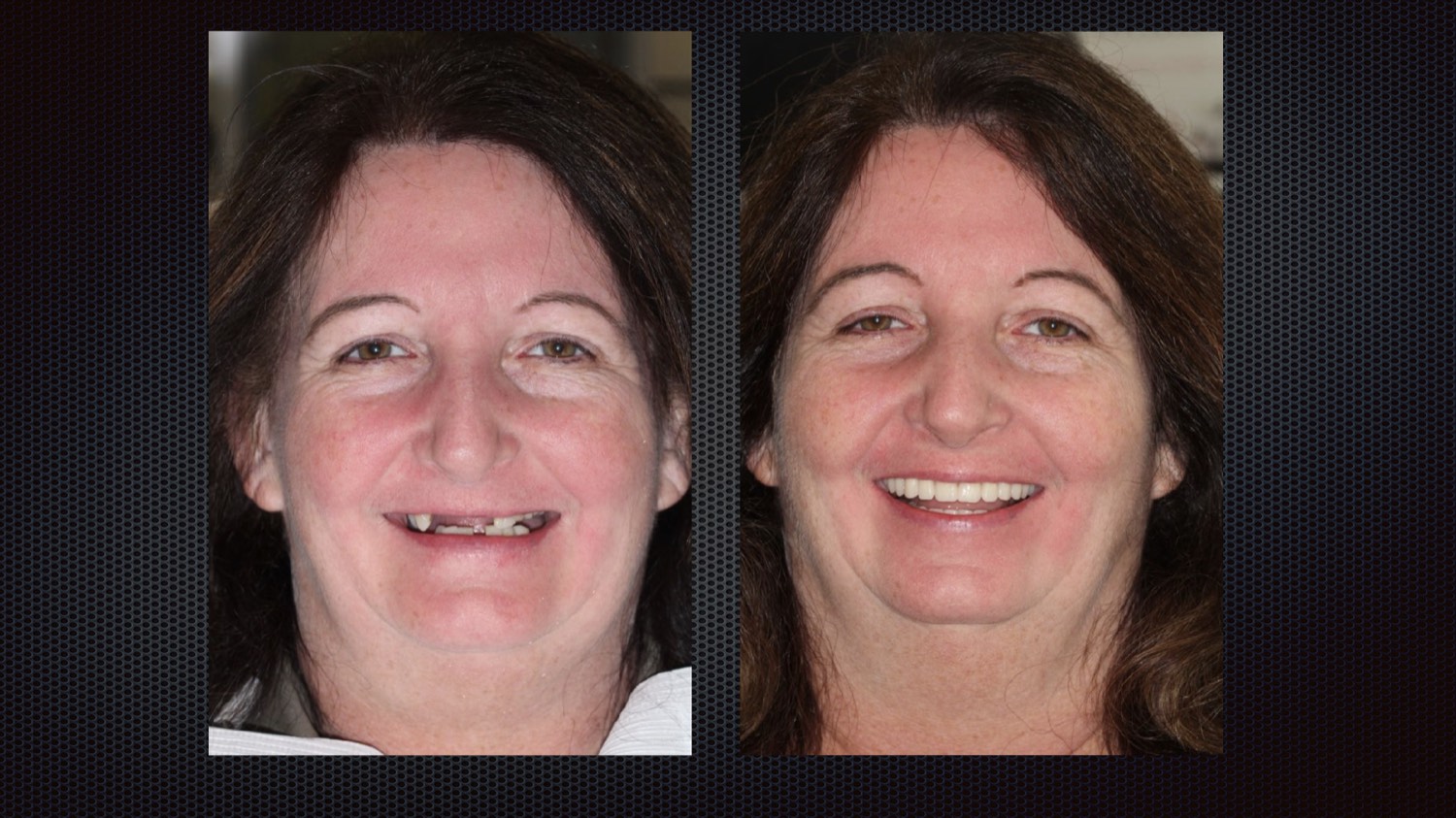 Before and after full-arch implant results