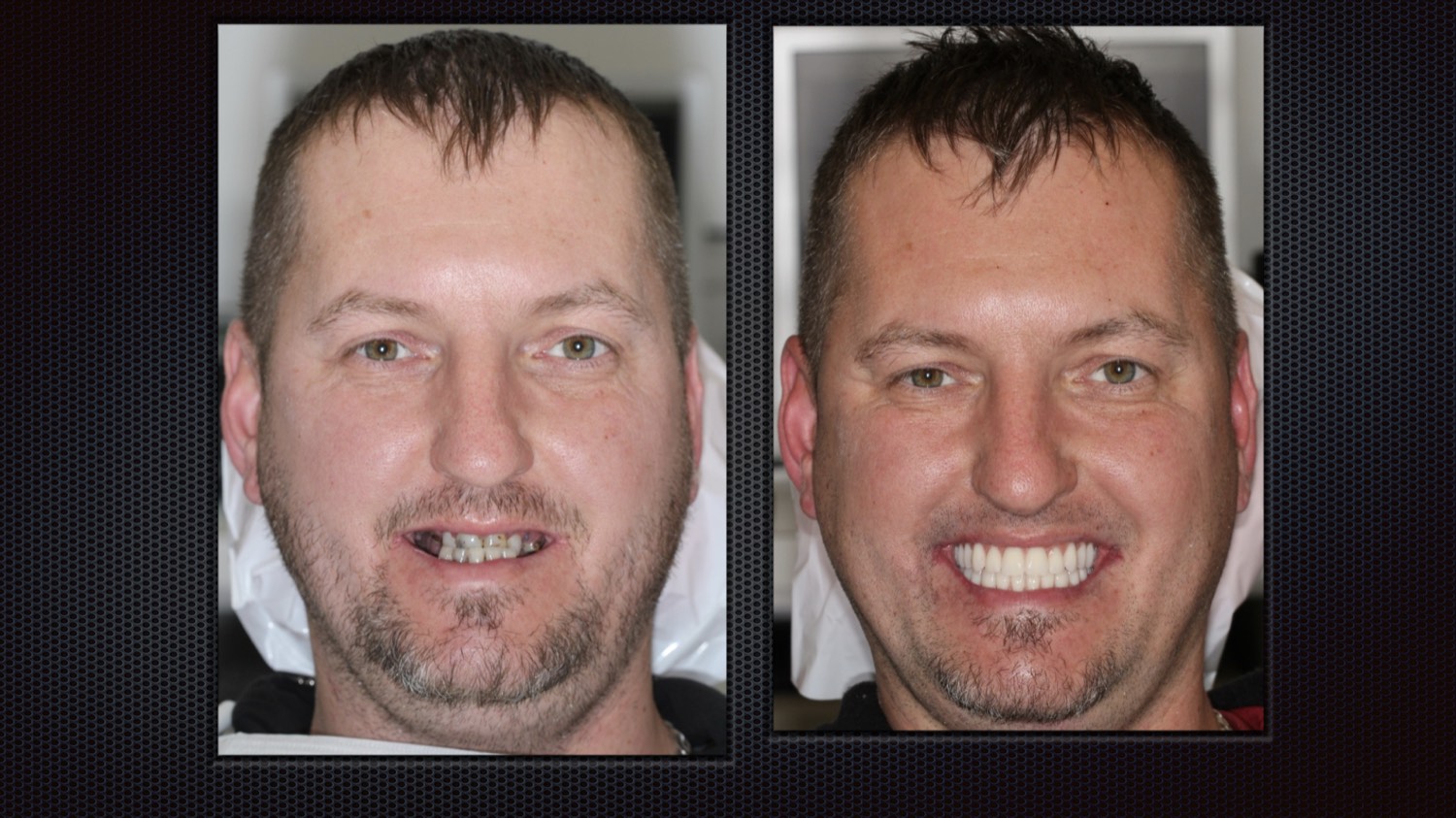 Before and after full-arch implant results