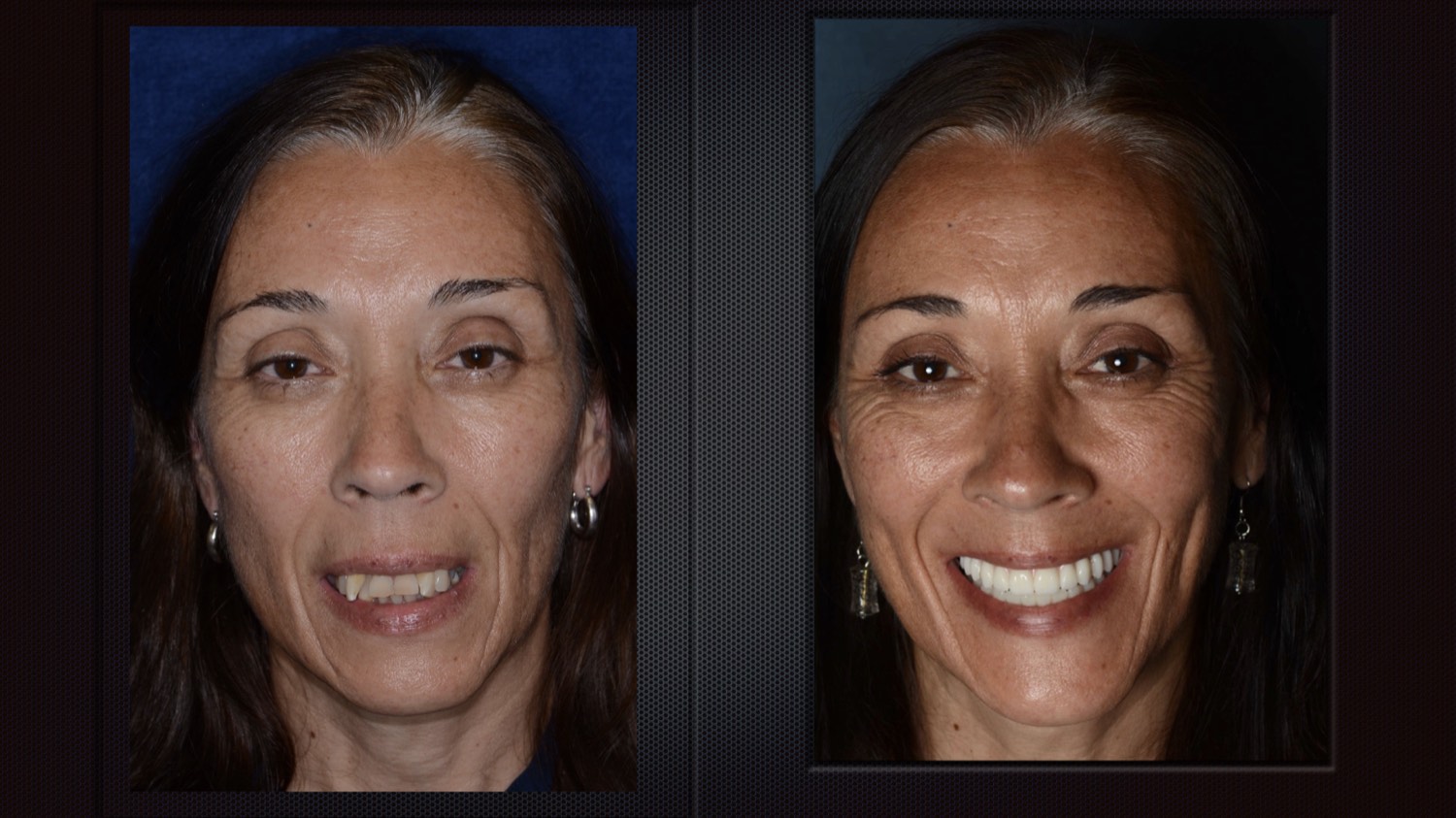 Before and after full-arch implant results
